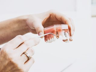Dental  Implants
