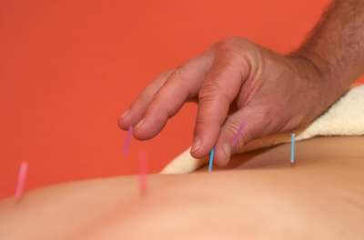 Akupunktur